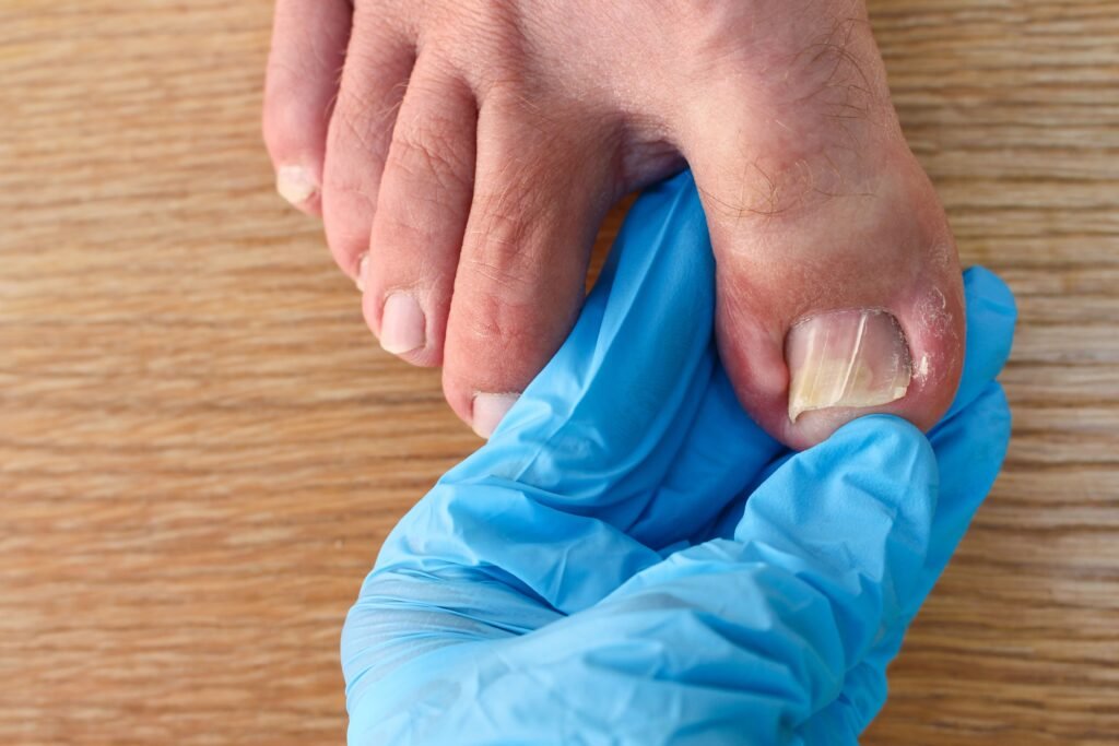 Home Remedies for Ingrown Toenail